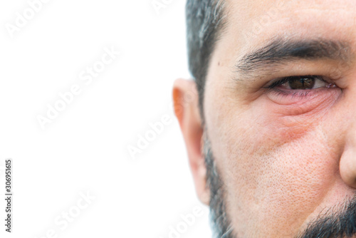 Man with stye in the eye with copy space for text photo