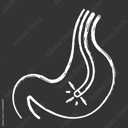 Endoscopy chalk icon. Gastroscopy process. Medical nonsurgical procedure. Healthcare services. Clinical treatment. Disease diagnostics. Visual inspection. Isolated vector chalkboard illustration