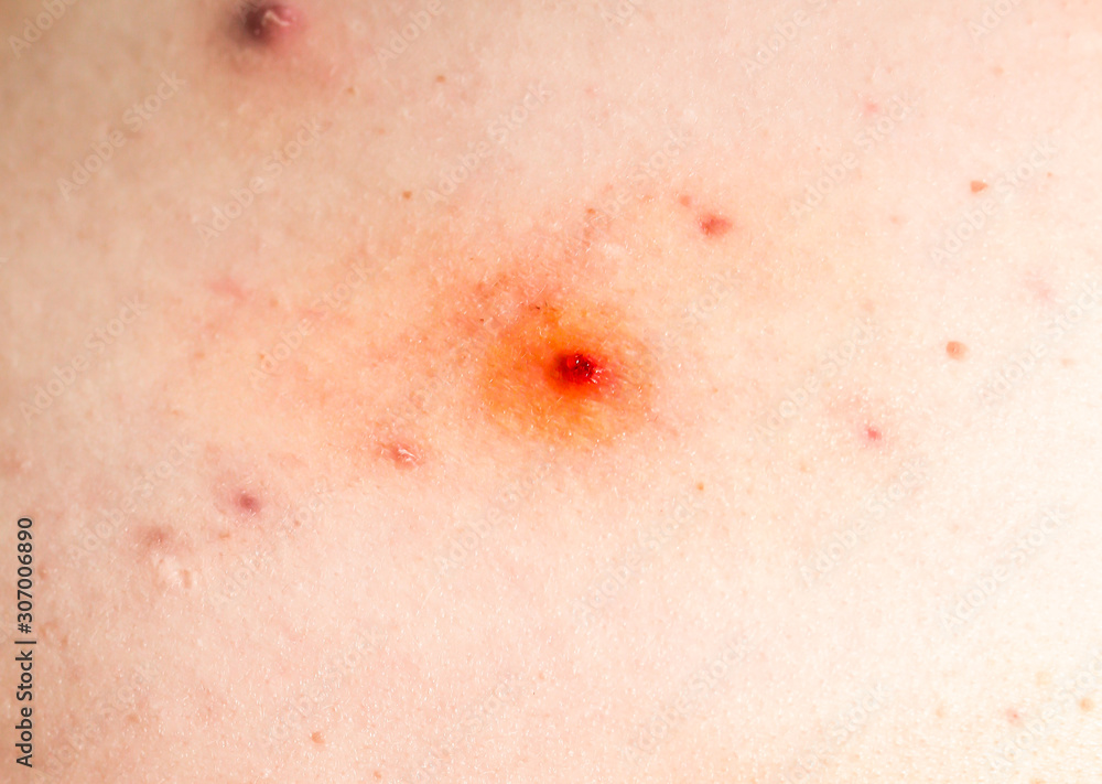 Many birthmarks on the girl's back. Medical health photo. Woman's oily skin with problems acne. Many birthmarks on the girl's back. Medical health photo. Woman's oily skin with problems acne.