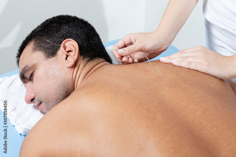 Therapist adjusting acupuncture needles on man back in aculpulture treatment. Therapist adjusting acupuncture needles on man back in aculpulture treatment.