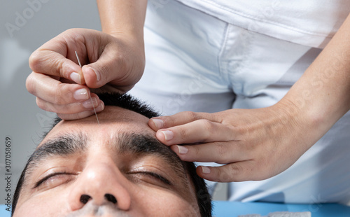 Detail of therapist adjusting acupuncture needle on head of man in aculpulture treatment.
