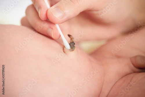 Cleaning newborn baby umbilical cord,treat the navel to a newborn baby ,first week of life