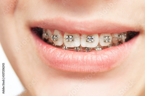 Braces for alignment of teeth on teeth at the boy. Medical dental concept