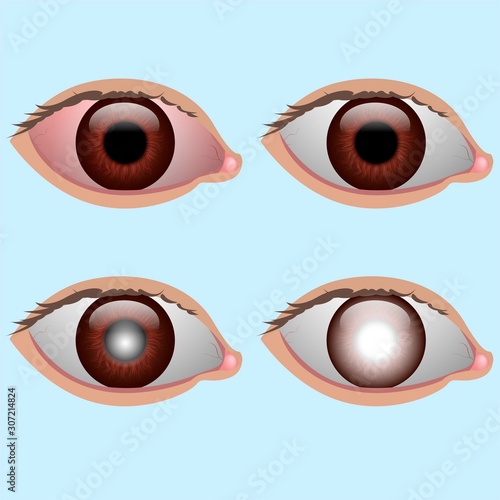 Human eye: redness of the eye, normal eye, cataract and glaucoma