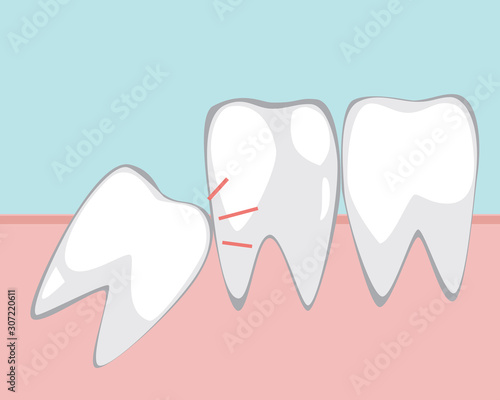 A wisdom tooth makes problem for molars in the gum, a vector stock illustration with adult jaw and teeth for orthodontic services