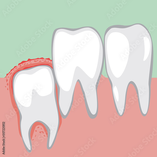 A wisdom tooth grows and the gums become inflamed and sore, a vector stock illustration with a problem with molars and teeth as a pain concept for a dental or orthodontic clinic