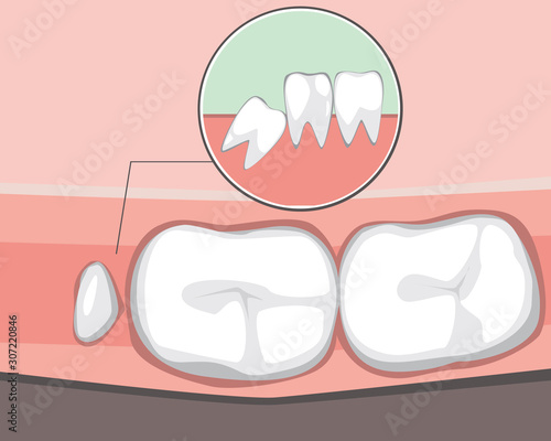 A wisdom tooth grows incorrectly and interferes with molars as a concept of tooth problems, a vector stock illustration with adult jaw infographic before visiting an orthodontist or dentist