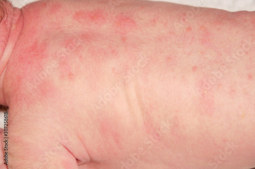 Newborn with easy baby acne on the back  from an adverse reaction  given at birth.