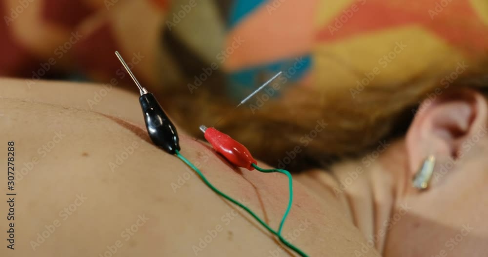 Close up of electrodes connected to needles on female patient's back. Acupuncture with electric stimulation. Close up of electrodes connected to needles on female patient's back. Acupuncture with electric stimulation.