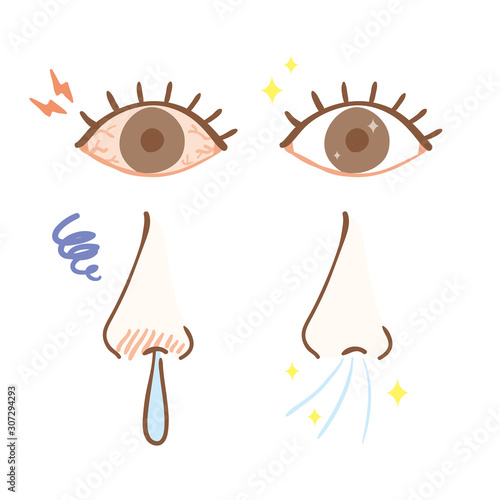 Rhinitis and congested eyes and before and after symptoms