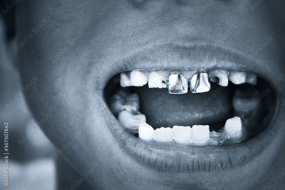 Naklejka premium A close up of the mouth with teeth On a black background