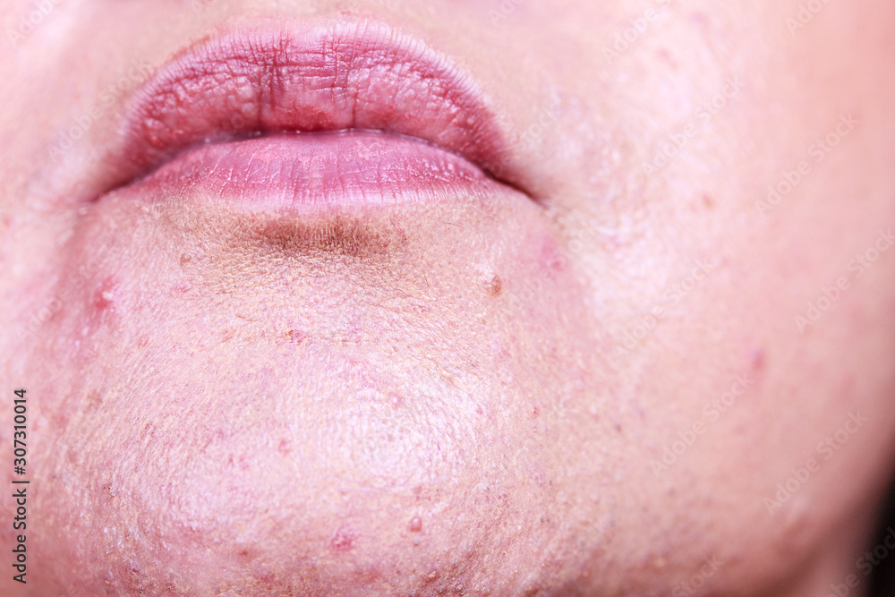 Obraz premium Female face with acne skin problem