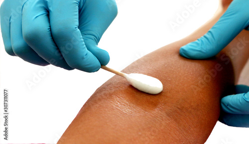 Close-up of a blood transfusion by a blood transfusion nurse for diagnosis and treatment. Bringing blood into the syringe (6)