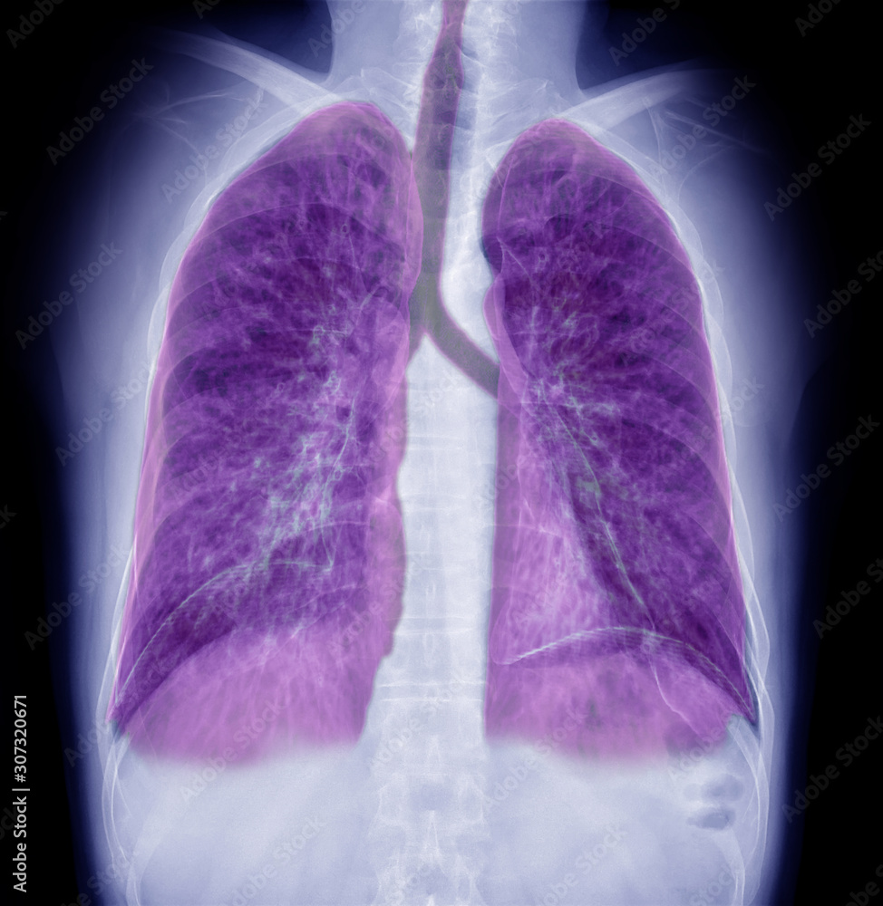 Chest Xray or XRay Image Of Human Chest with 3D rendering of lung for