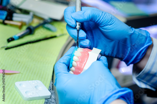 Close-up of denture manufacturing process. Tooth reconstruction.