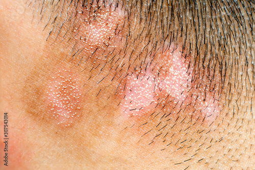 Close up view of laser therapy for (Vitiligo) Abnormal skin Melanocyte Pigment.