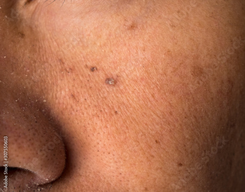 mole nevus nevo on the skin face
