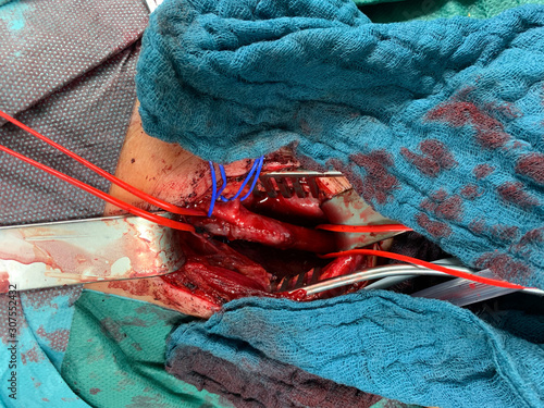 In carotid surgery, the ateria carotis is exposed and wrapped in red and blue reins photo
