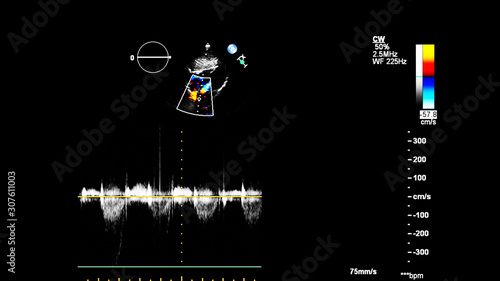 Image of the heart during transesophageal ultrasound with Doppler mode.