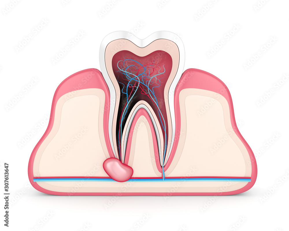 3d render of tooth in gums with cyst 3d render of tooth in gums with cyst