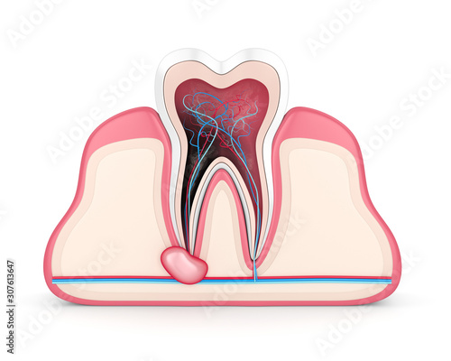 3d render of tooth in gums with cyst photo