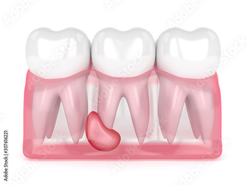 Foto 3d render of teeth in gums with cyst