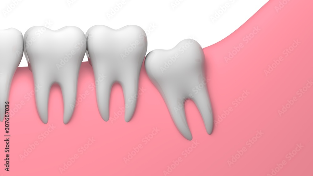 Wisdom tooth partial eruption impaction illustration, 3D-rendering, white background