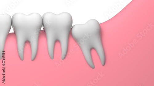 Wisdom tooth partial eruption impaction illustration, 3D-rendering, white background
