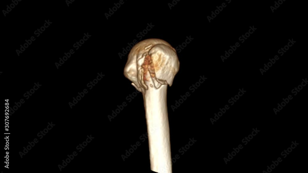 CT Elbow 3D rendering image turn around on the screen showing fracture head of humerus bone. CT Elbow 3D rendering image turn around on the screen showing fracture head of humerus bone.