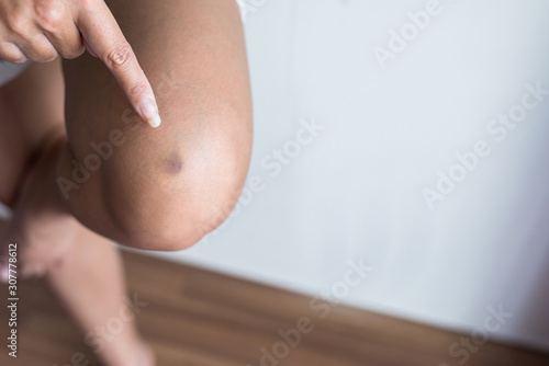 Bruise on woman knee skin,Healthy skin body care concept,Copy space for text on white background