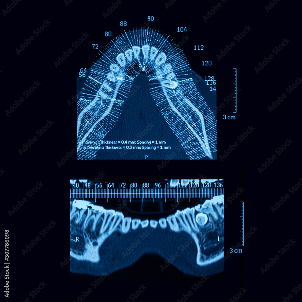 Computed tomography (CT-scan) of mandibular teet Stock Photo | Adobe Stock