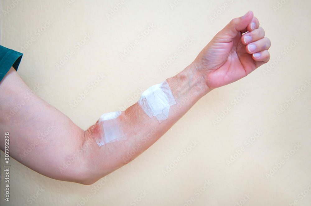 The bandage from hemodialysis to the arm from the treatment of dialysis  through a blood vessel Photos | Adobe Stock