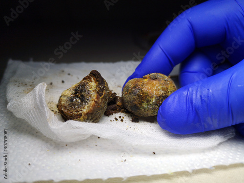 Gallstones close up. Calculi in the hands of the surgeon after laparoscopy, surgery to remove the gallbladder. Complications of gallstone disease. Cut bile crystals. Mobile photo photo