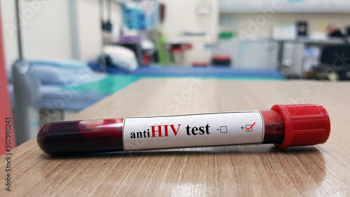 Positive Anti HIV test and laboratory sample of blood testing for diagnosis HIV infection or AIDS disease. Infectious disease and diagnostic test concept