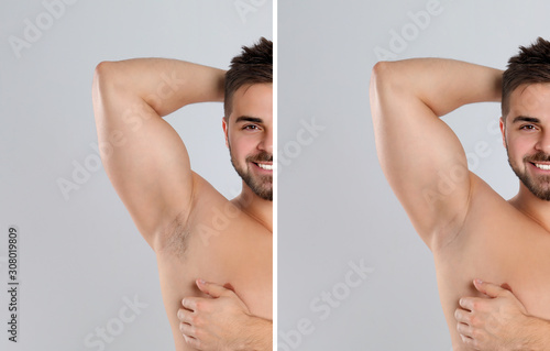 Collage of man showing armpit before and after epilation on light grey background photo