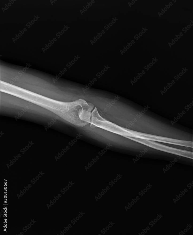 x-ray of the normal elbow joint. traumatology and orthopedics, medical diagnostics, rheumatology x-ray of the normal elbow joint. traumatology and orthopedics, medical diagnostics, rheumatology