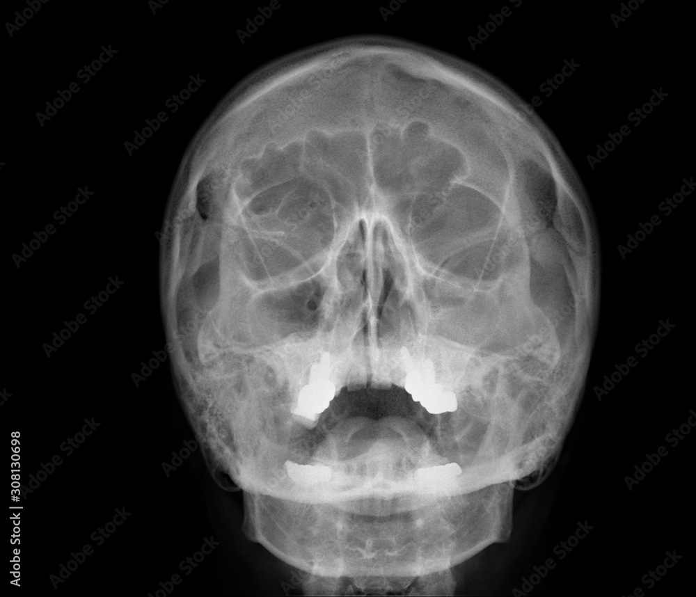 radiography of the paranasal sinuses of the skull, medical diagnosis radiography of the paranasal sinuses of the skull, medical diagnosis