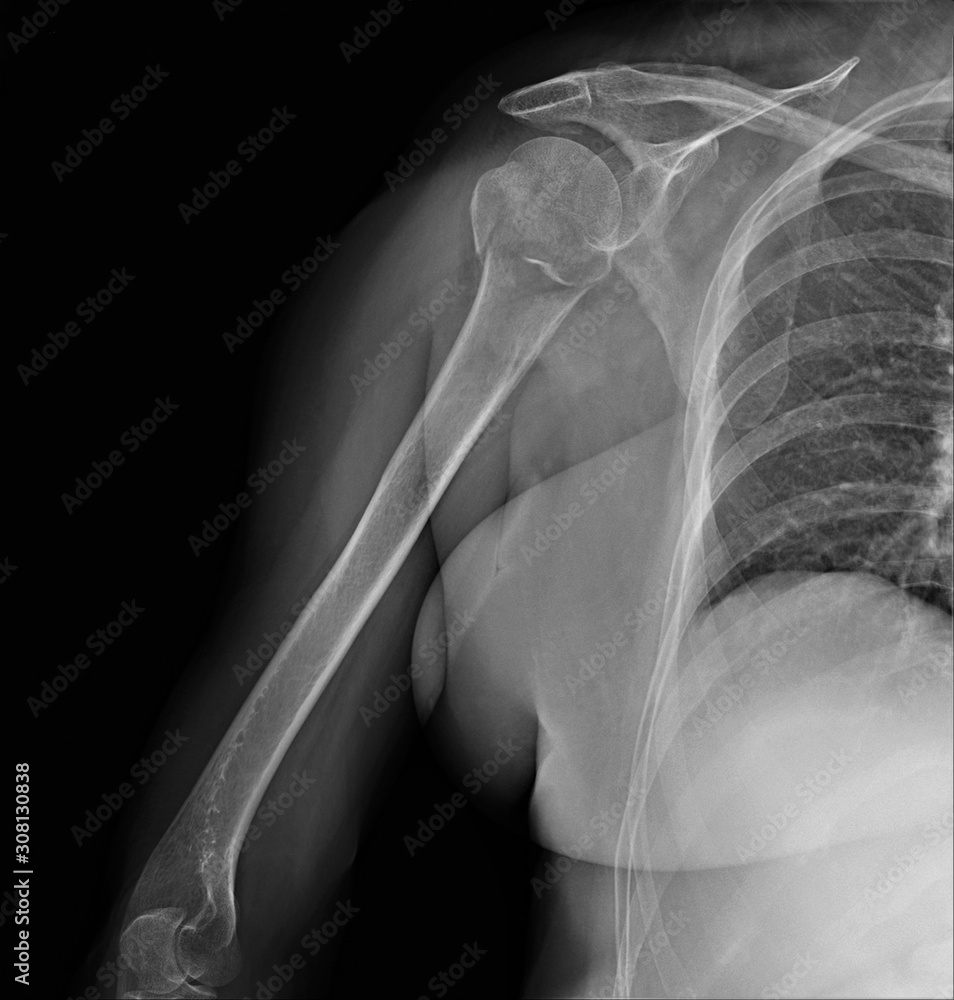 radiography of the shoulder joint in direct projection with a fracture of the head of the humerus, Traumatology and orthopedics, traumatology, sports injury radiography of the shoulder joint in direct projection with a fracture of the head of the humerus, Traumatology and orthopedics, traumatology, sports injury