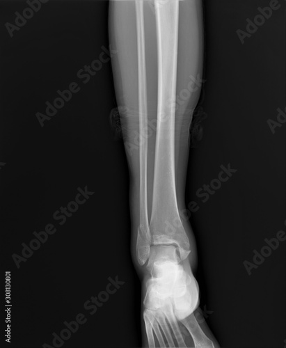 radiograph of the ankle joint with a fracture of the outer ankle without displacement, traumatology, medical diagnostics