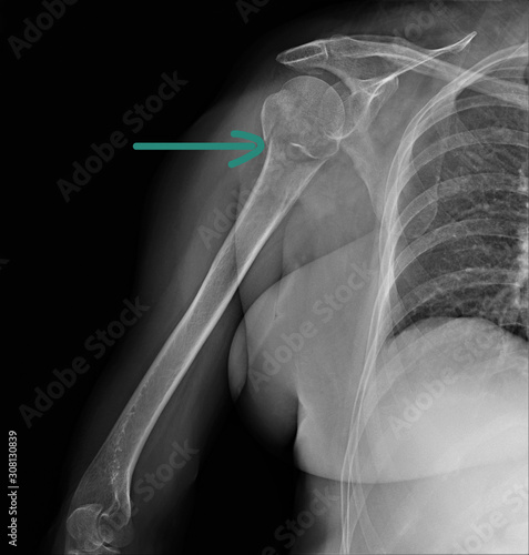 radiography of the shoulder joint in direct projection with a fracture of the head of the humerus, Traumatology and orthopedics, traumatology, sports injury