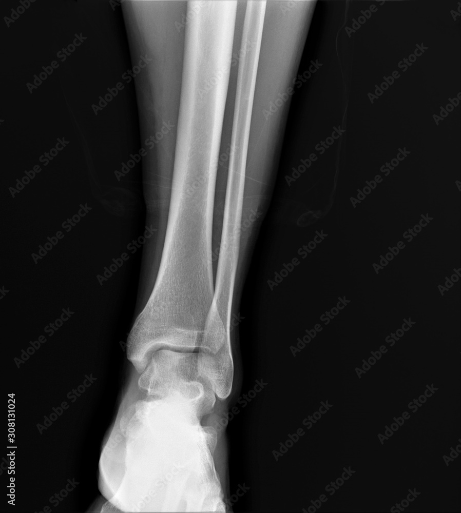 normal radiograph of the ankle joint in front projection,osteoarthritis osteoporosis normal radiograph of the ankle joint in front projection,osteoarthritis osteoporosis