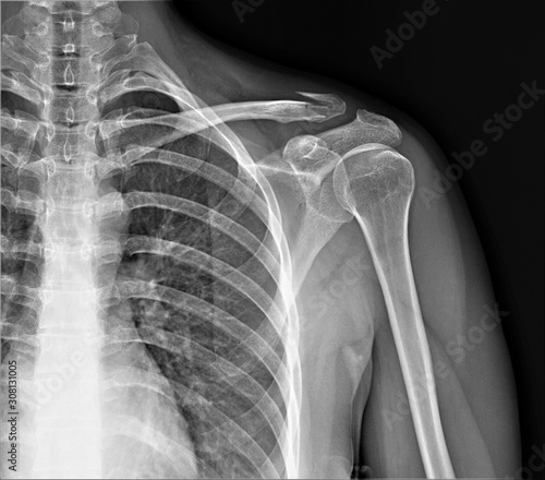radiography of the shoulder joint and ribs in direct projection with a fracture of the collarbone, Traumatology and orthopedics