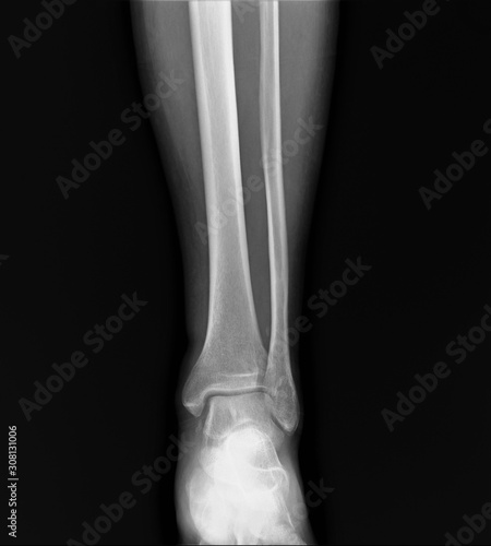 normal radiograph of the ankle joint in front projection osteoarthritis osteoporosis