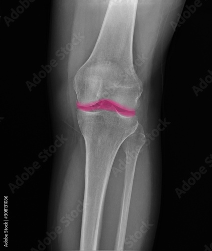 radiography of the knee joint with arthrosis, medical diagnostics, rheumatology