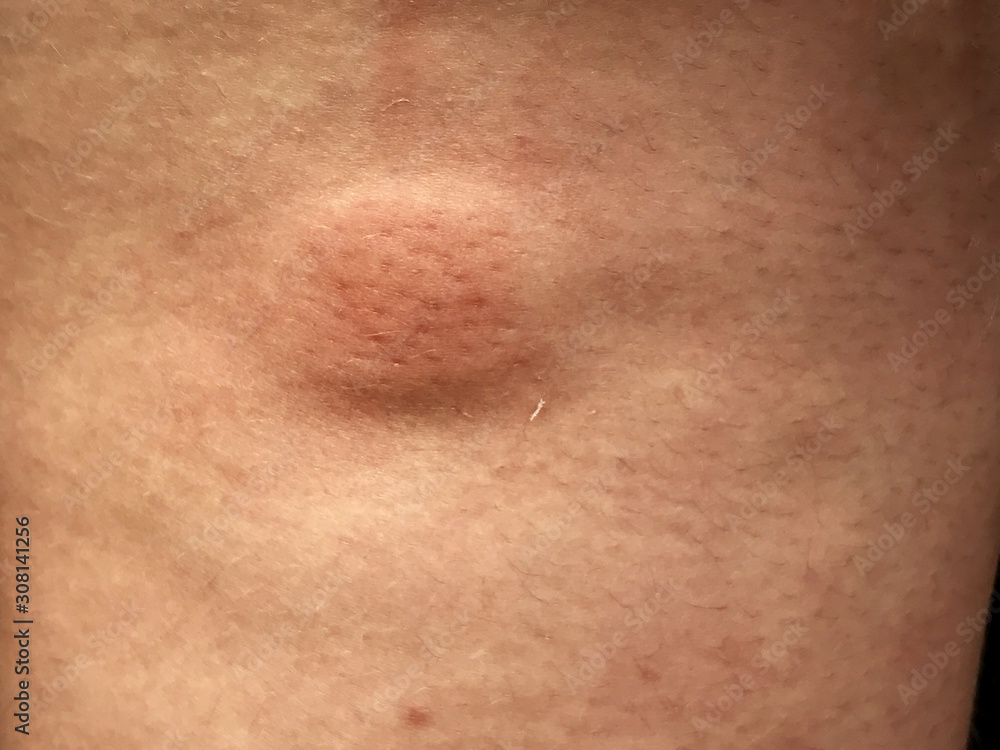 Fototapeta premium Swollen Mosquito Bite