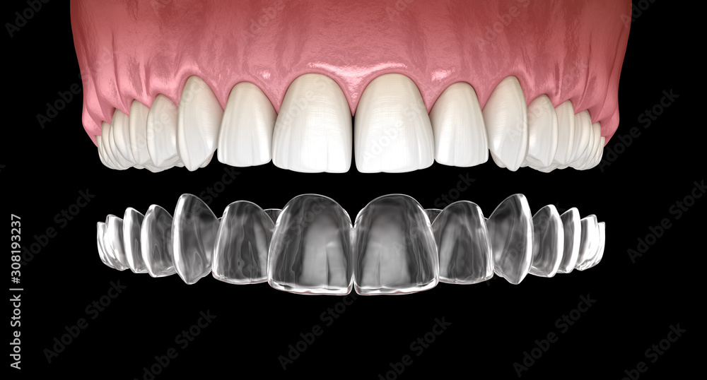 Obraz premium Invisalign braces or invisible retainer. Medically accurate dental 3D illustration