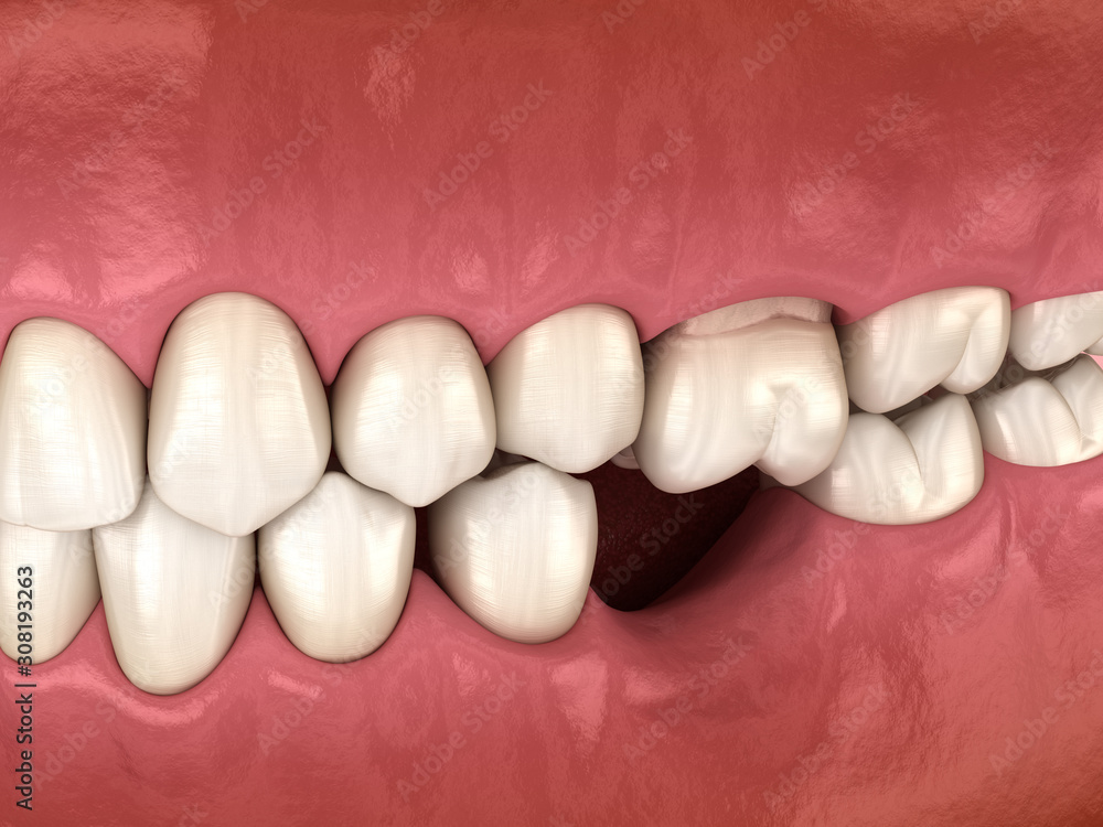 Teeth shift deformatiuon after losing molar tooth. 3D illustration of Popov Godon phenomenon Teeth shift deformatiuon after losing molar tooth. 3D illustration of Popov Godon phenomenon