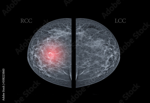  X-ray Digital Mammogram  or mammography  both side of the breast  CC view  for finding Breast cancer in women  showing Breast Calcifications in right breast. photo