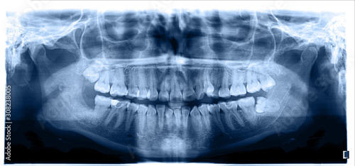 Close up. Panoramic image of the jaw  the location of the atypical   pathological wisdom tooth  third molar . Blue tone image.