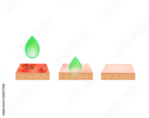peeling for acne. Inflamed skin acne. Acne purulent. The anatomical structure of the skin. Infographics. Vector illustration on isolated background.